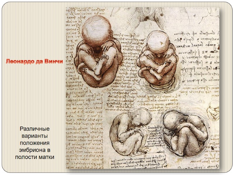 Различные варианты положения эмбриона в полости матки Леонардо да Винчи